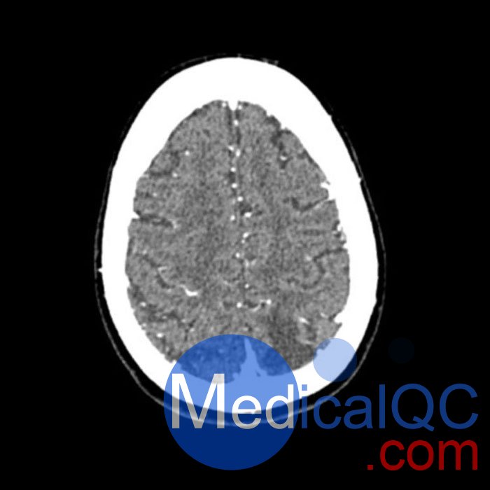 WEK50-03動脈瘤頭模,WEK50-03血管造影CTA頭模影像圖