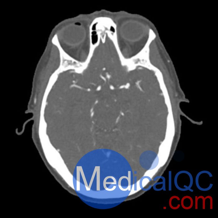 WEK50-03動脈瘤頭模,WEK50-03血管造影CTA頭模影像圖