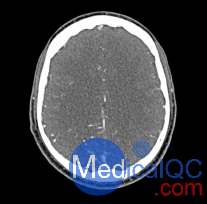 WEK50-04 CTA頭模，帶AVM CTA頭模，WEK50-04 CT血管造影頭模成像效果圖