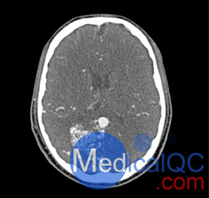 WEK-5005腦血管造影頭模，WEK-5005頭模， CTA AVM頭模成像效果圖