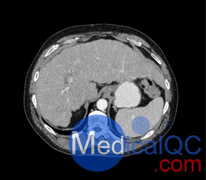 WEK53-04肝硬化腹部模體,WEK53-04門靜脈期腹部模體產(chǎn)品成像圖