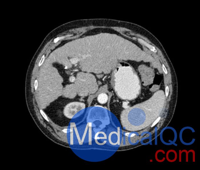 WEK53-04肝硬化腹部模體,WEK53-04門靜脈期腹部模體產(chǎn)品成像圖